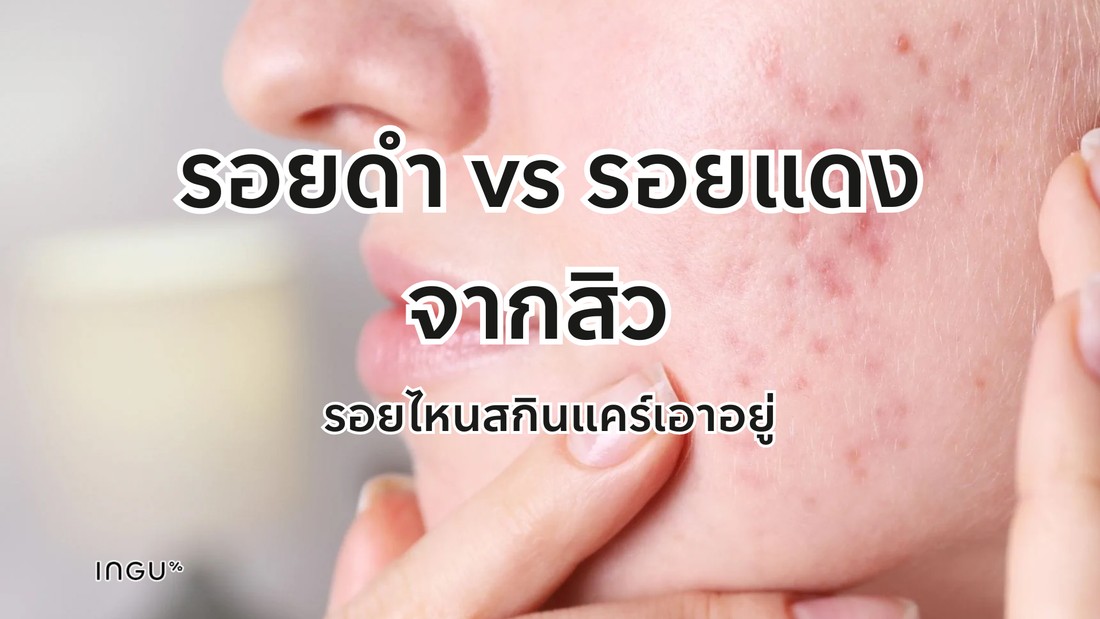 รอยดำ vs รอยแดงจากสิว รอยไหนสกินแคร์เอาอยู่